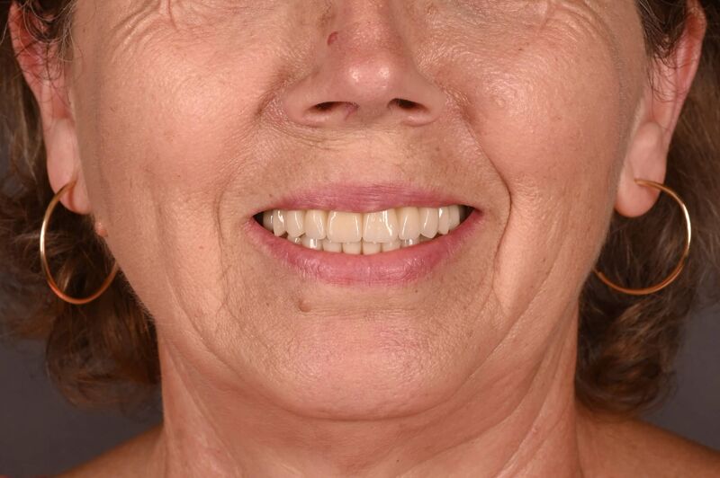 boteanu ilinca - dupa